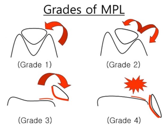 Grados de luxaci&oacute;n patelar