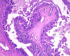 Neoplasia maligna de mama