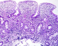 Corte histol&oacute;gico de yeyuno cel&iacute;aco